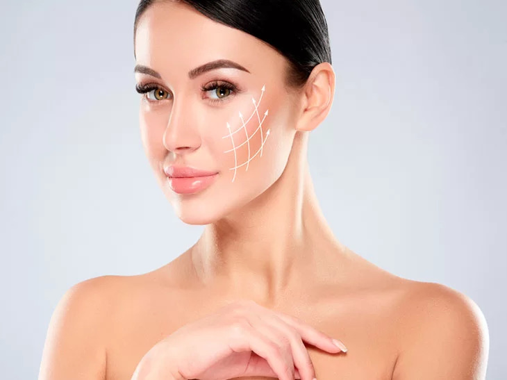 Na imagem é possível ver uma mulher branca com cabelos pretos, ela está parada na frente de uma parede cinza claro. Em seu rosto é possível ver linhas destacando a área de atuação dos bioestimuladores de colágeno.