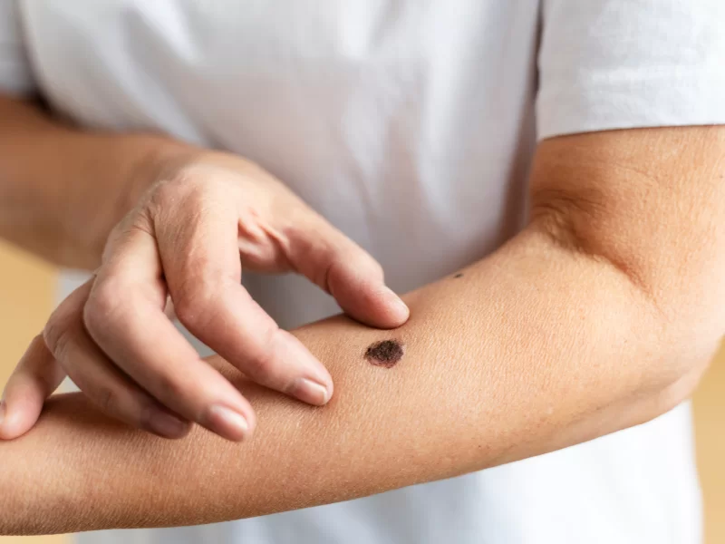 A imagem mostra o antebraço de uma pessoa com pele branca. A pessoa está com dois dedos ao redor de uma mancha no antebraço. O sinal tem cor marrom, com bordas irregulares e em coloração mais clara. Ela veste camiseta branca. O fundo da imagem é amarelo.
