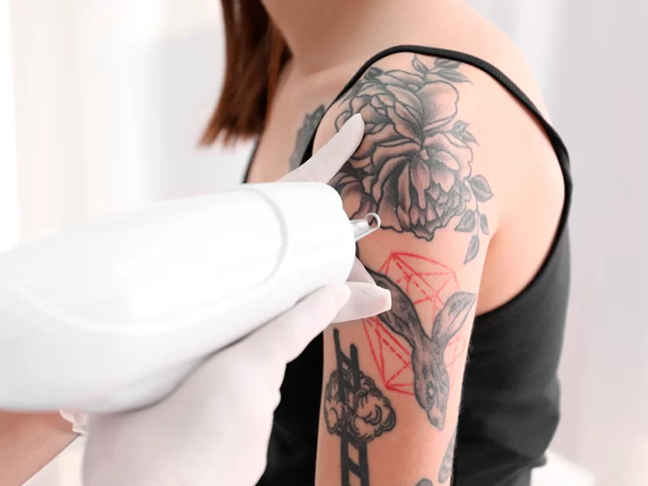 Mulher antes de sessão de remoção de tatuagem com laser, realizada pela Dra. Sheila Matielo.