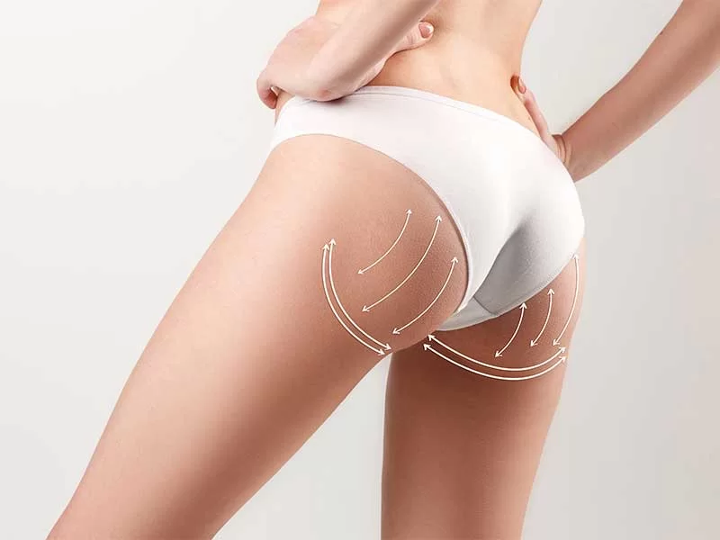 Na imagem é possível ver o corpo de uma mulher com roupas íntimas brancas. Ela está de costas e possui flechas desenhadas em seus glúteos, indicando o procedimento de aumento de glúteos.