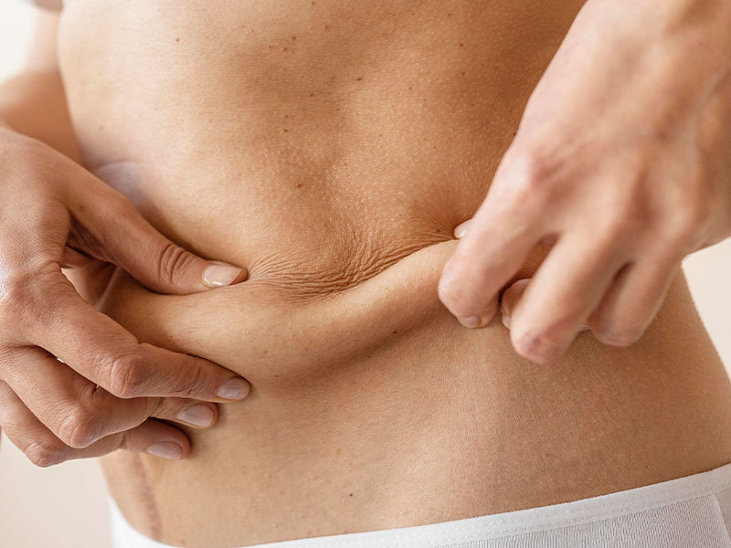 Close-up do abdômen feminino demonstrando flacidez abdominal indicada para tratamento dom bioestimuladores de colágeno na Clínica Dra. Sheila Matielo.