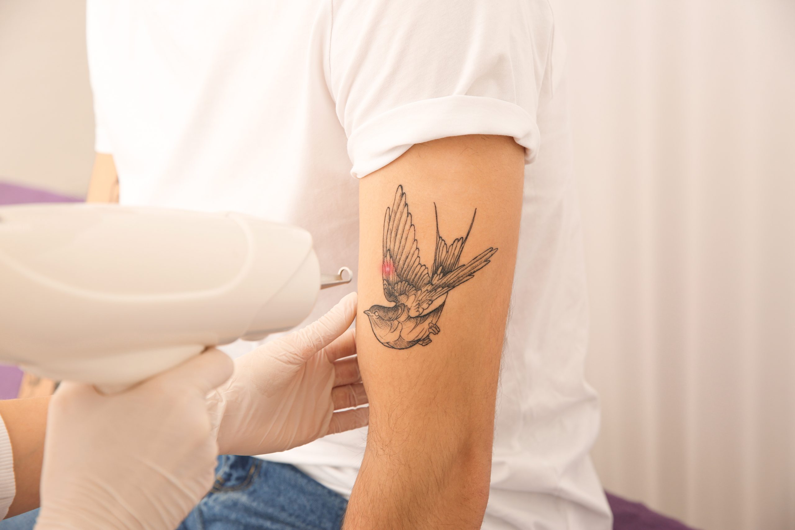 Procedimento de remoção de tatuagem a laser, demonstrando a tecnologia agindo sobre o pigmento de forma segura.